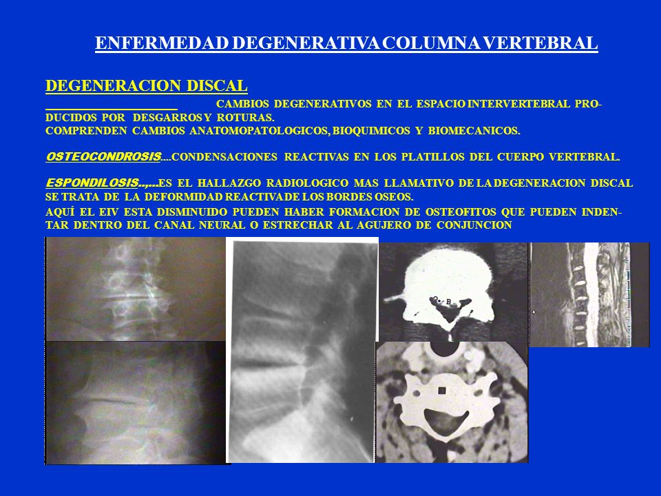 El dolor agudo en el cuello la infracción del equilibrio